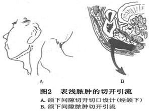 下颌下间隙感染