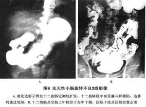 先天性肠旋转不良