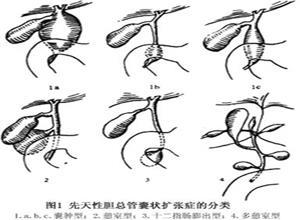 先天性胆管囊状扩张