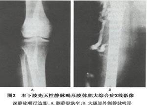 先天性静脉畸形肢体肥大综合征