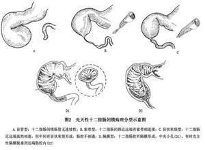 先天性十二指肠闭锁
