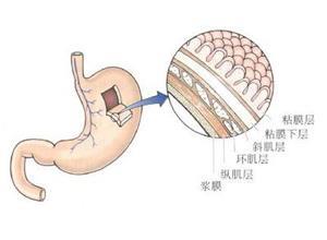 先天性胃壁肌层缺损