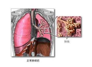 成人呼吸窘迫综合征