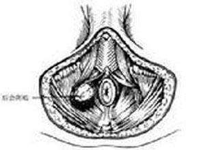 经腹会阴直肠癌根治术后盆底腹膜疝