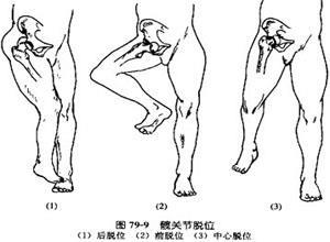 髋关节前脱位