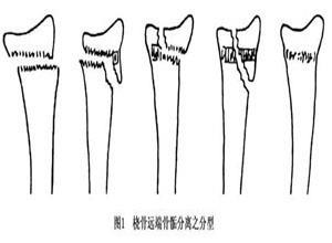 桡骨远端骨骺分离