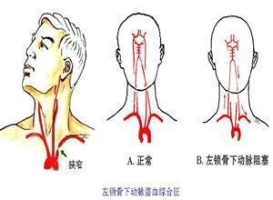 锁骨下动脉盗血综合征