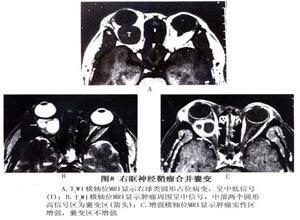 眼眶神经鞘瘤