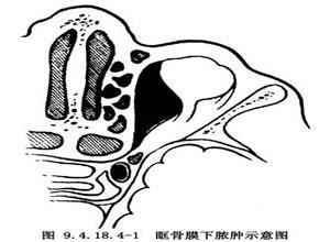 眶骨膜下脓肿