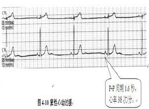 窦性心动过缓