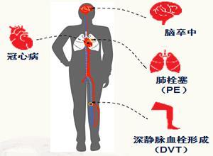 血栓形成