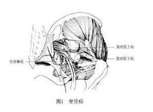 坐骨疝