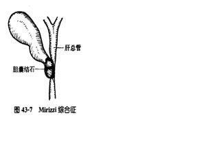 Mirizzi综合征