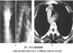 食管受压性吞咽困难