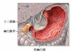 成人肥大性幽门狭窄