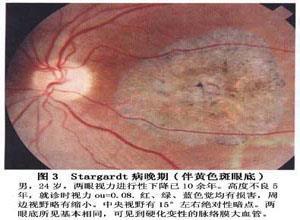 Stargardt病