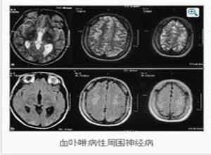 血卟啉病性周围神经病