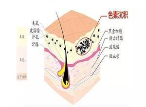 药物或化学物质所致的色素沉着