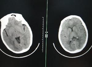 外伤性硬膜下积液