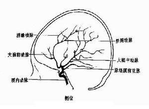 外伤后颈内动脉闭塞