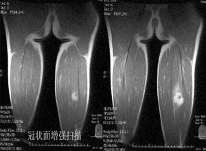 骨神经鞘瘤