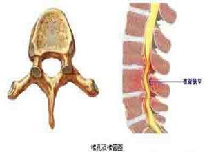 胸椎椎管狭窄症