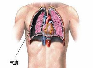 老年肺炎