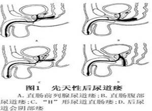 先天性后尿道瘘