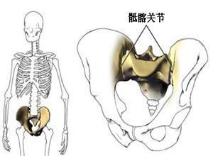 退变性骶髂关节炎