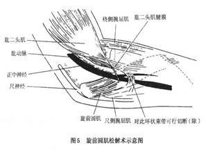 旋前圆肌综合征