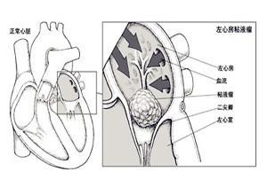 心脏黏液瘤