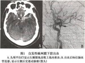 自发性蛛网膜下腔出血