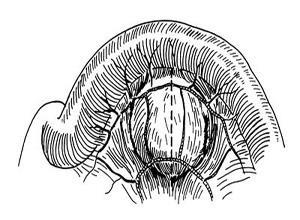 肠系膜囊肿