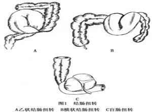 横结肠扭转