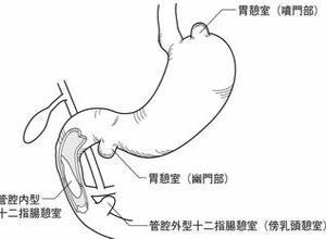胃憩室