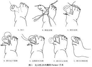 先天性拇内翻