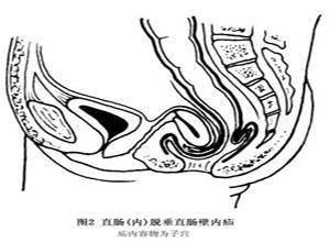 直肠脱垂直肠壁内疝