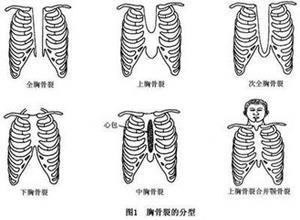 胸骨裂