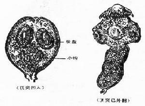 脑棘球蚴病