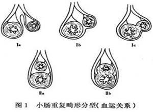 小肠重复畸形