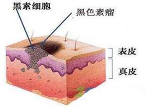 阴道黑色素瘤