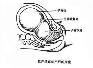 软产道异常性难产