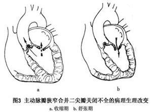 二尖瓣和主动脉瓣的疾患