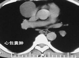 心包囊肿与心包憩室