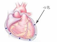 心包转移瘤