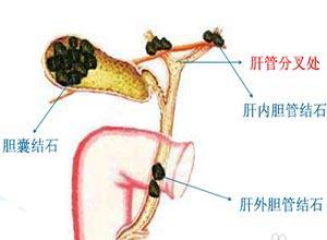 胆囊结石