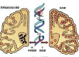 致死性家族性失眠症