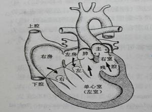 单心室