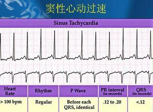 窦性心动过速