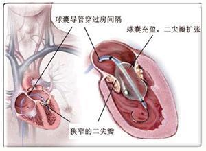 二尖瓣狭窄